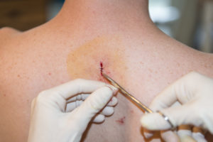 cirurgia câncer de pele